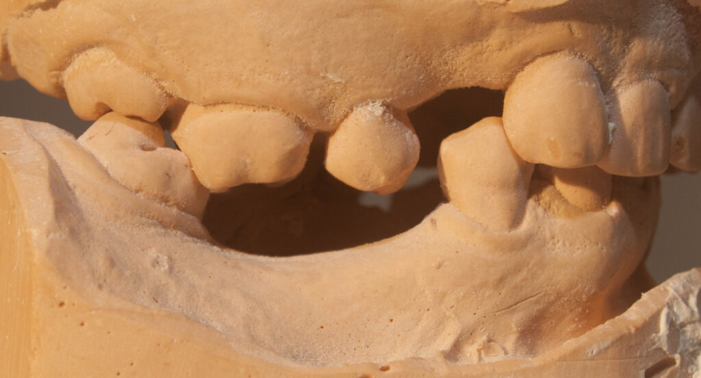 V.15 The Collapsed Bite full mouth rehabilitation The Center for