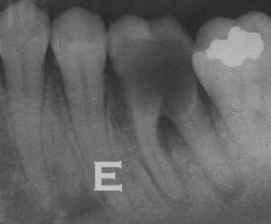 Dental Decay and Tooth Infection - III.1 – The Center for Dental Education