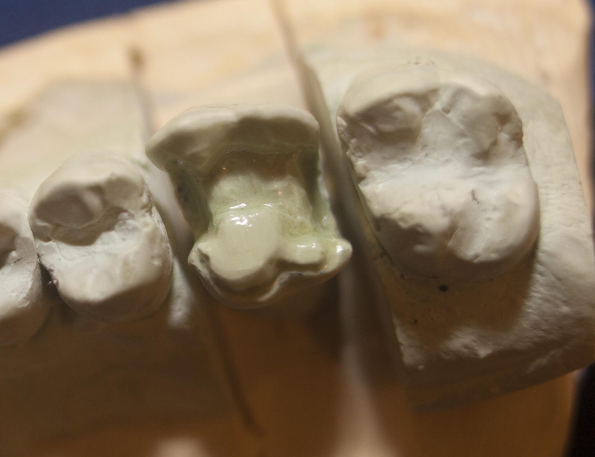 Dental Gold Onlays and Crowns Posterior Teeth V.6 The Center for