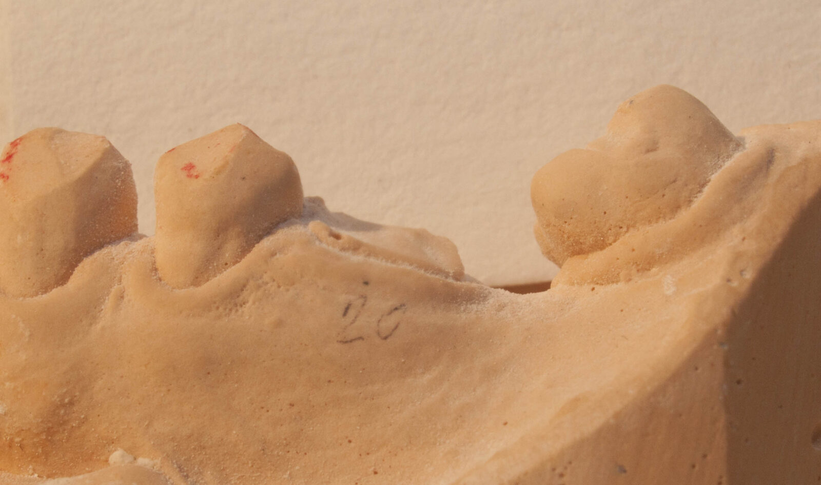 The Collapsed Dental Bite V.15 The Center for Dental Education