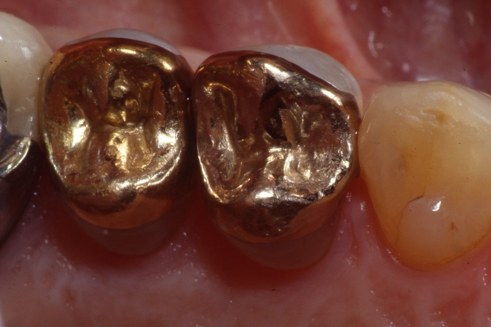 Dental Gold Onlays and Crowns Posterior Teeth V.6 The Center for