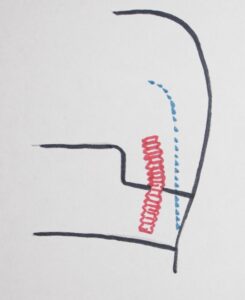 Retentive Pin The Dental Buildup - V.9 – The Center for Dental Education